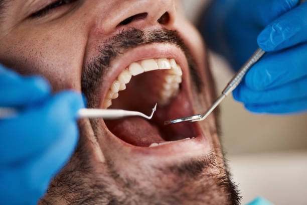 Best Emergency Dentist for Knocked-Out Tooth in Southmont, NC