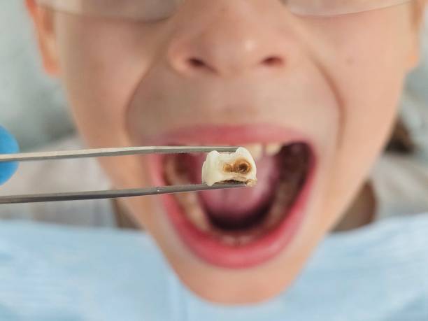 Best Emergency Dentist for Knocked-Out Tooth in Southmont, NC